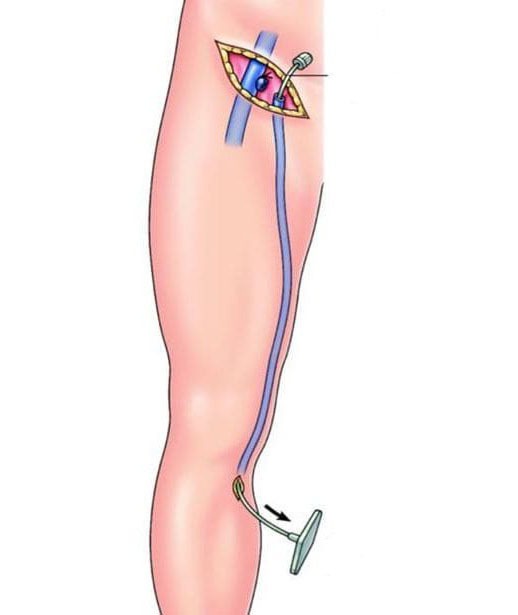 safenectomia-abieerta-rotated